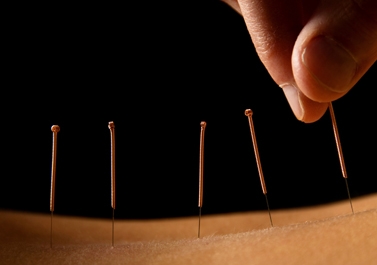 Acupuncture - Doctor Mosaraf Ali Acupuncture - Doctor Mosaraf Ali